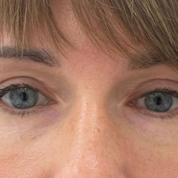 Лазерная блефаропластика
                    Медицинский центр Аура Киев