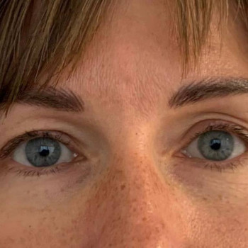 Лазерная блефаропластика
                    Медицинский центр Аура Киев