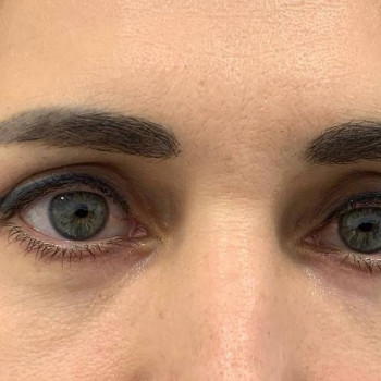 Лазерная блефаропластика
                    Медицинский центр Аура Киев