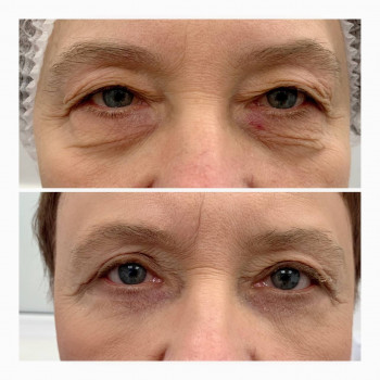 Лазерная блефаропластика
                    Медицинский центр Аура Киев