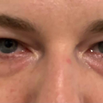 Лазерная блефаропластика
                    Медицинский центр Аура Киев