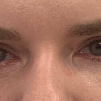 Лазерная блефаропластика
                    Медицинский центр Аура Киев