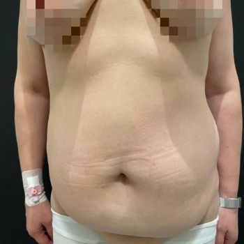 Абдоминопластика - от 2050€ все включено
                    Медицинский центр Аура Киев