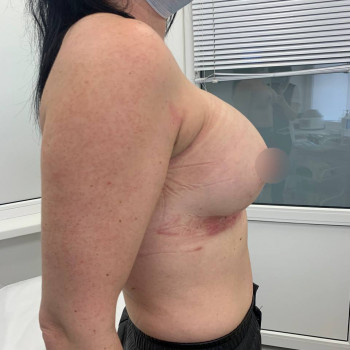 Увеличение груди от 2300€ все включено
                    Медичний центр Аура Київ