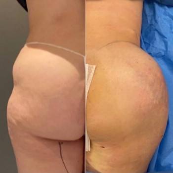 Липофилинг ягодиц
                    Медичний центр Аура Київ