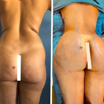 Липофилинг ягодиц
                    Медичний центр Аура Київ