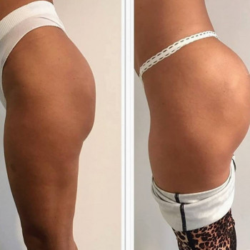 Липофилинг ягодиц
                    Медичний центр Аура Київ