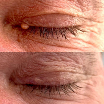 Удаление родинки
                    Медичний центр Аура Київ