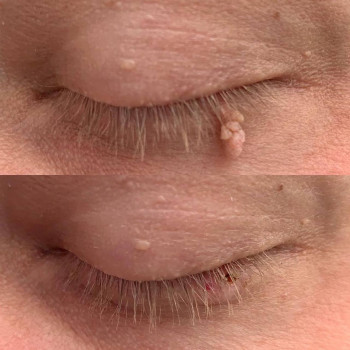 Удаление родинки
                    Медичний центр Аура Київ