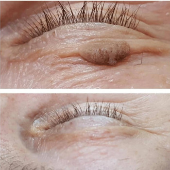 Удаление родинки
                    Медичний центр Аура Київ