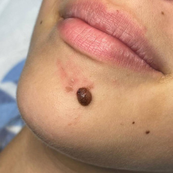 Удаление родинки
                    Медичний центр Аура Київ