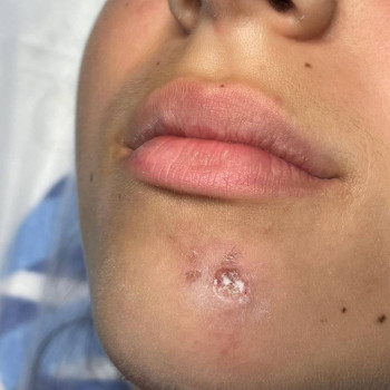 Удаление родинки
                    Медичний центр Аура Київ