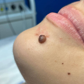 Удаление родинки
                    Медичний центр Аура Київ