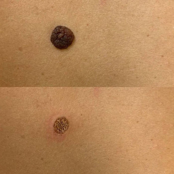 Удаление родинки
                    Медичний центр Аура Київ