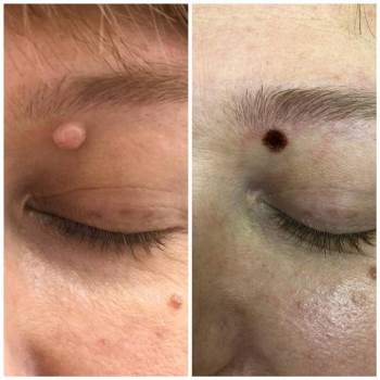 Удаление родинки
                    Медичний центр Аура Київ