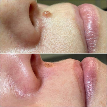 Удаление родинки
                    Медичний центр Аура Київ