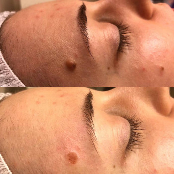 Удаление родинки
                    Медичний центр Аура Київ