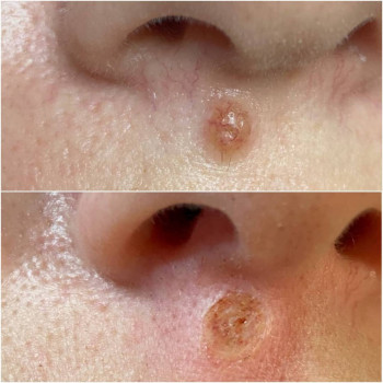 Удаление родинки
                    Медичний центр Аура Київ