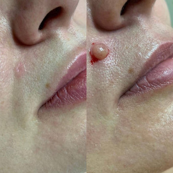 Удаление родинки
                    Медичний центр Аура Київ