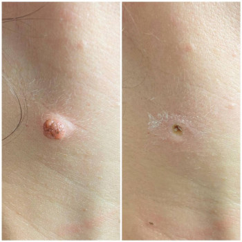 Удаление родинки
                    Медичний центр Аура Київ