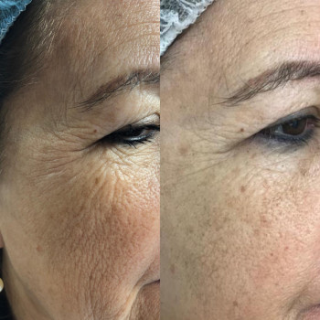 Биоревитализация
                    Косметолог Анастасия Одесса