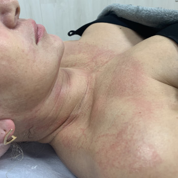 Плазматичний ефект після ферментотерапії