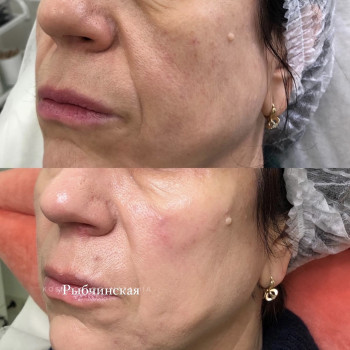 PDRN полінуклеотиди
                    Врач-косметолог Наталия Киев