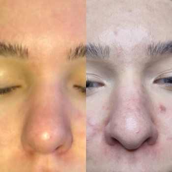 Звуження носа