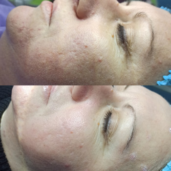 Комби чистка