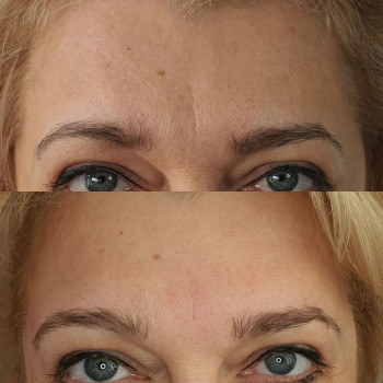 Массаж лица - миолифтинговый массаж. Авторская методика.