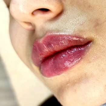 Увеличение губ
                    Косметолог-естетист Анна Харків