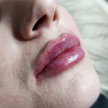 Увеличение губ
                    Косметолог-естетист Анна Харків