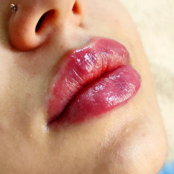 Увеличение губ
                    Косметолог-естетист Анна Харків