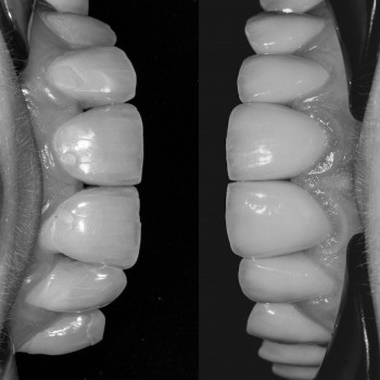 Керамічні реставрації