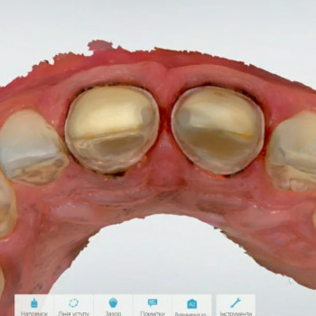 Інтраоральний скан
