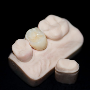 Керамічна коронка