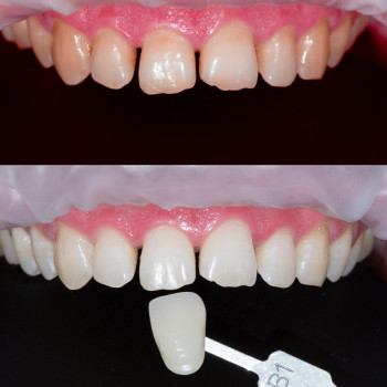 Відбілювання