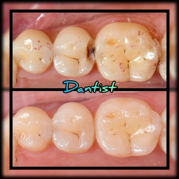 ЛЕЧЕНИЕ ЗУБОВ