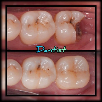 ЛЕЧЕНИЕ ЗУБОВ