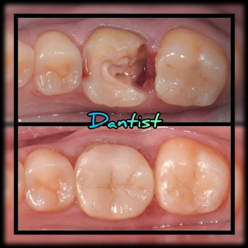 ЛЕЧЕНИЕ ЗУБОВ