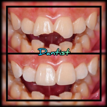 РЕСТАВРАЦИЯ ЗУБОВ