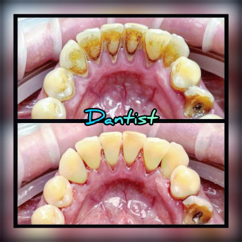 ПРОФЧИСТКА ЗУБОВ