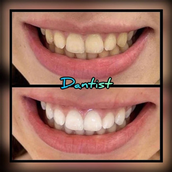 ОТБЕЛИВАНИЕ ЗУБОВ