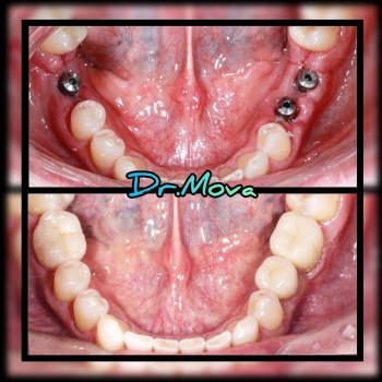 ИМПЛАНТАЦИЯ ЗУБОВ