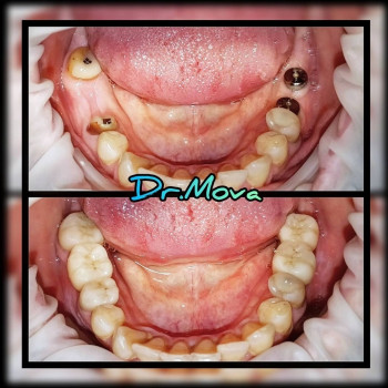 ИМПЛАНТАЦИЯ ЗУБОВ