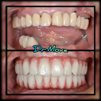 ИМПЛАНТАЦИЯ ЗУБОВ