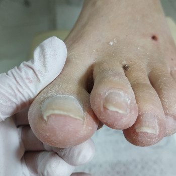 Вростаючі нігті