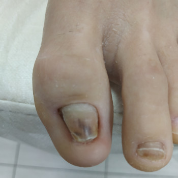 Травма нігтя