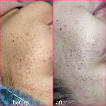 Лечение акне
                    Косметолог-эстетист Анна Харьков