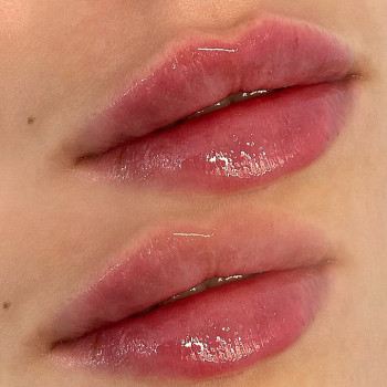 Контурная пластика губ
                    Салон краси WISE BEAUTY LAB Київ
